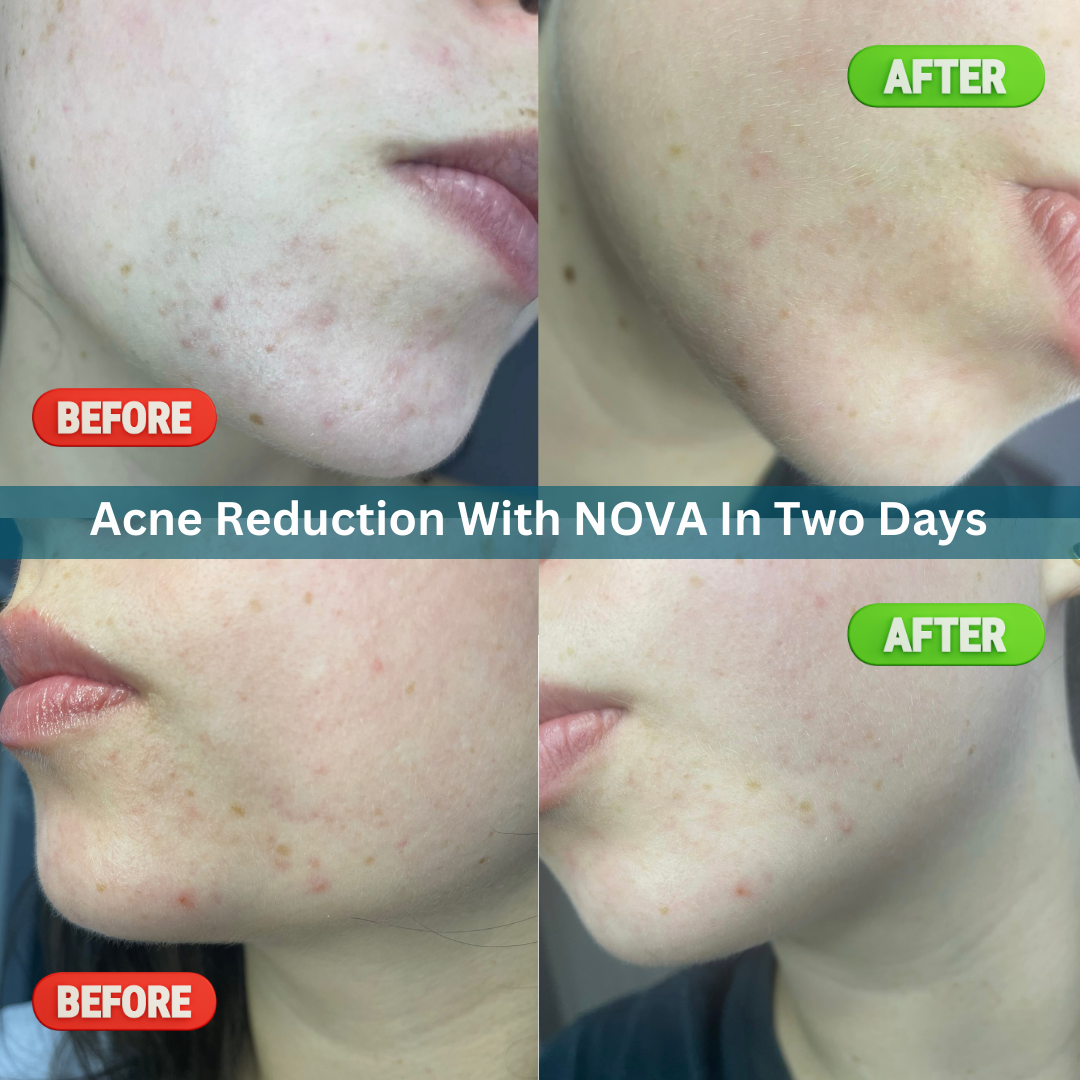 Nova Face Serum Rejuvenation | Starter Set